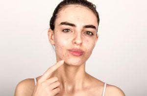 Essential-Oils-For-Acne-Scars