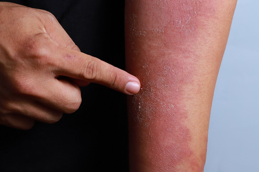 Everything You Need to Know About Fungal Infections and How to Treat Them
