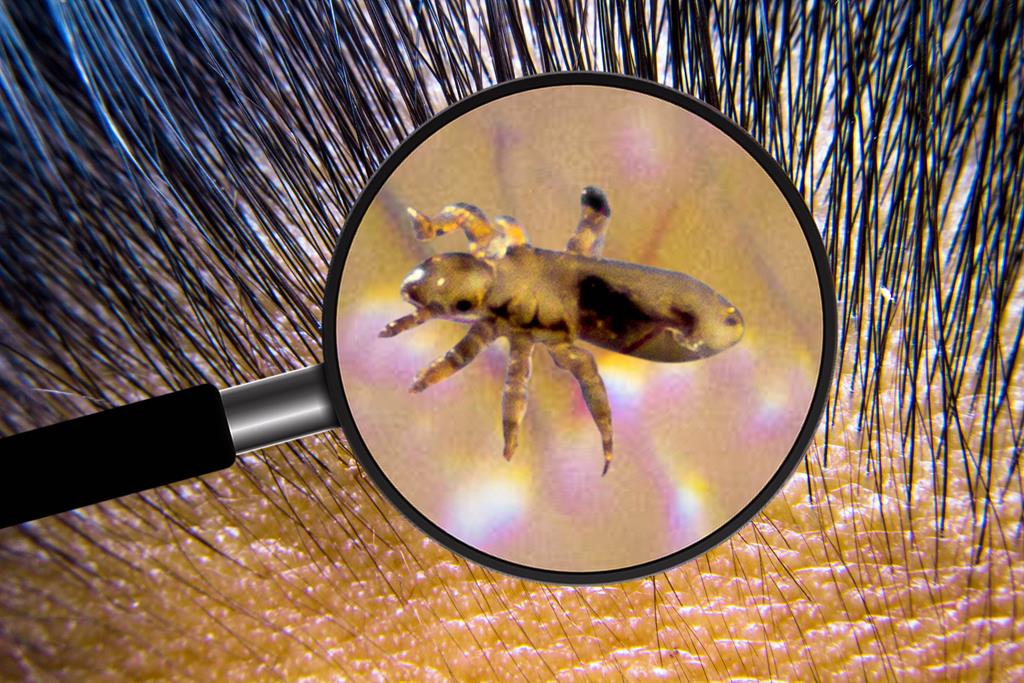 tea tree oil to remove lice