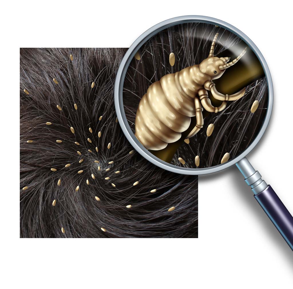 How to get rid of Head Lice
