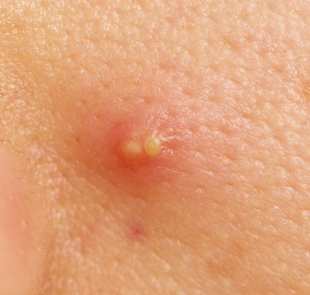 10 Effective Home Remedies to Cure Boils